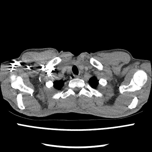 Accessory left horizontal fissure with lingular pneumonia (Radiopaedia 53763-59843 Axial C+ CTPA 9).jpg