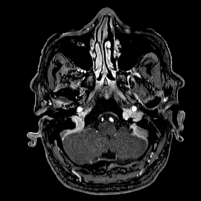 Accessory middle cerebral artery (Radiopaedia 73114-83828 Axial MRA 14).jpg