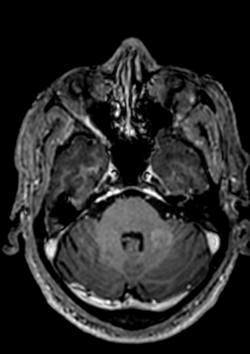 Accessory middle cerebral artery (Radiopaedia 73114-83828 Axial T1 C+ 119).jpg