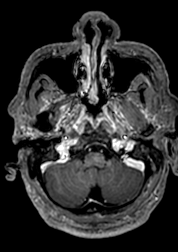 Accessory middle cerebral artery (Radiopaedia 73114-83828 Axial T1 C+ 162).jpg