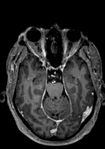 Accessory middle cerebral artery (Radiopaedia 73114-83828 Axial T1 C+ 89).jpg