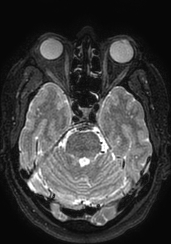 File:Accessory middle cerebral artery (Radiopaedia 73114-83828 Axial T2 142).jpg