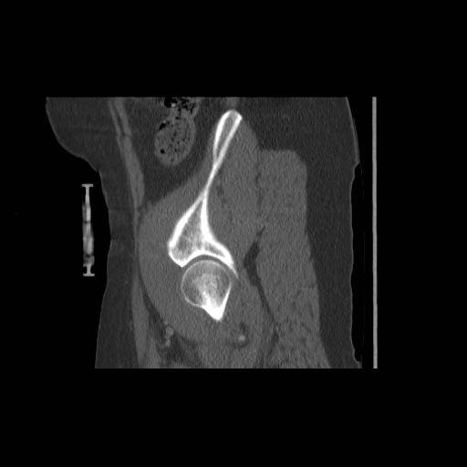 File:Acetabular fracture (Radiopaedia 13193-13212 Sagittal bone window 18).jpg