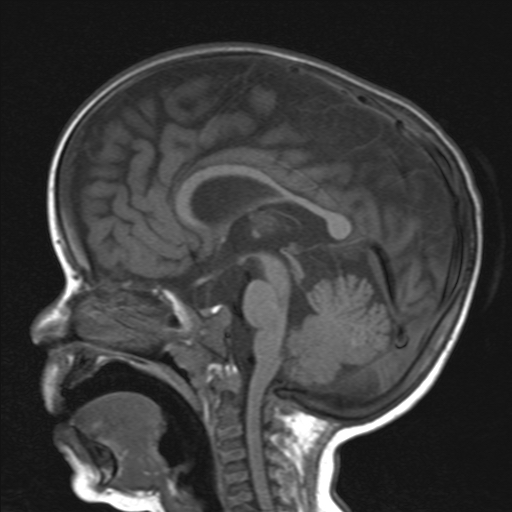 File:Achondroplasia (Radiopaedia 3114).jpg