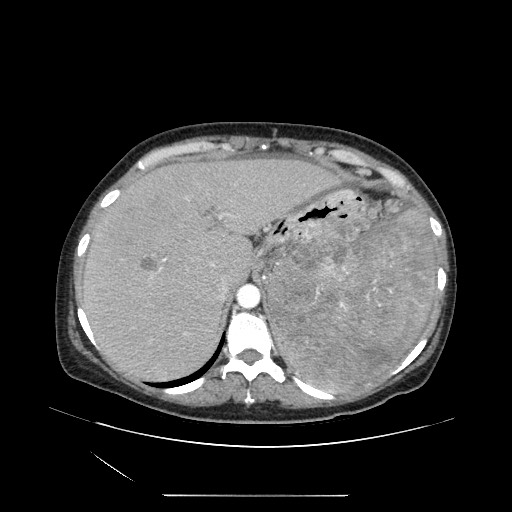 Acinar cell carcinoma of the pancreas (Radiopaedia 75442-86669 Axial C+ portal venous phase 26).jpg