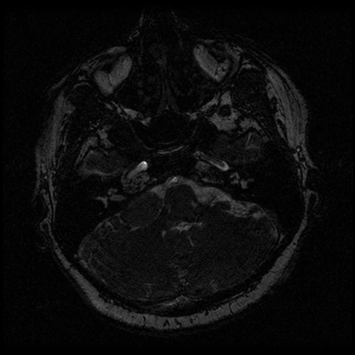 Acoustic schwannoma (Radiopaedia 33045-34060 Axial T2 20).png