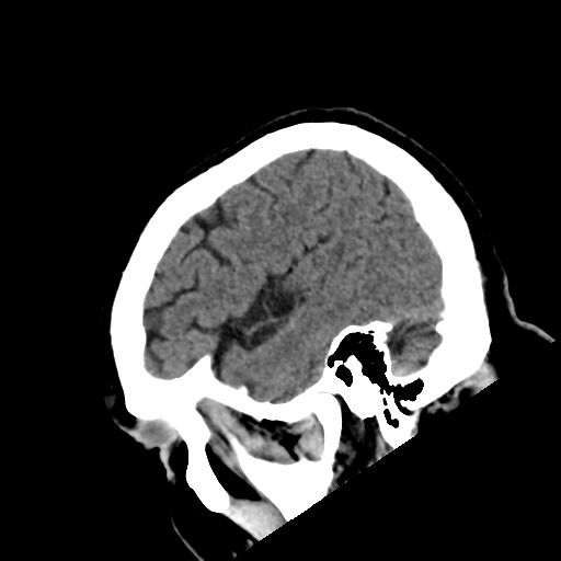 File:Acoustic schwannoma (Radiopaedia 55729-62280 Sagittal non-contrast 7).png