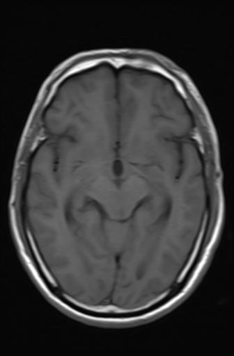 File:Acoustic schwannoma - probable (Radiopaedia 20386-20292 Axial T1 9).jpg
