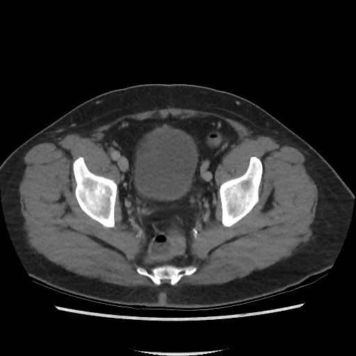 File:Active colonic bleed on CT (Radiopaedia 49765-55025 Axial C+ delayed 73).jpg