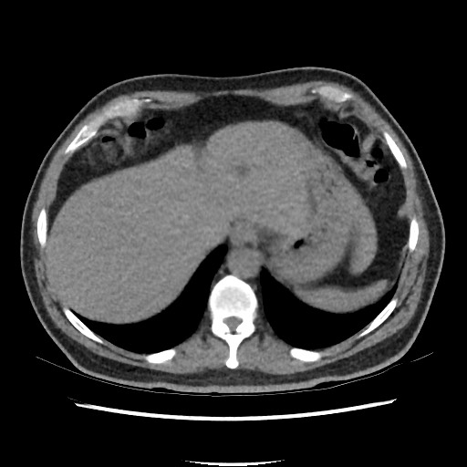 Active colonic bleed on CT (Radiopaedia 49765-55025 Axial non-contrast 11).jpg