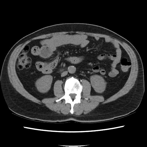Active colonic bleed on CT (Radiopaedia 49765-55025 Axial non-contrast 39).jpg