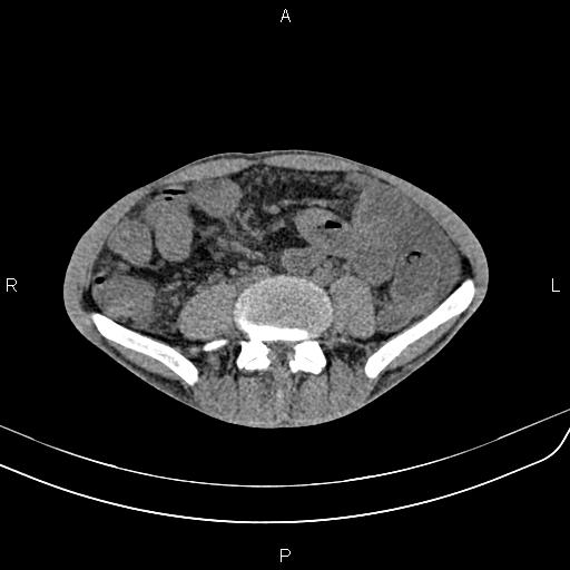 File:Active crohn disease (Radiopaedia 87133-103397 Axial non-contrast 64).jpg