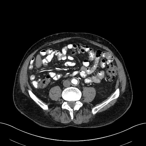 Active lower gastrointestinal bleeding - diverticular (Radiopaedia 61203-69106 Axial C+ arterial phase 6).jpg