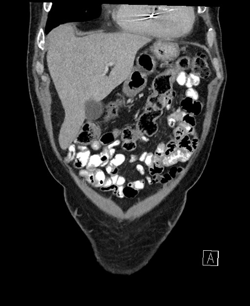Active lower gastrointestinal bleeding - diverticular (Radiopaedia 61203-69106 Coronal C+ portal venous phase 32).jpg