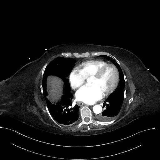 Active renal extravasation with large subcapsular and retroperitoneal hemorrhage (Radiopaedia 60975-68796 Axial C+ arterial phase 9).jpg