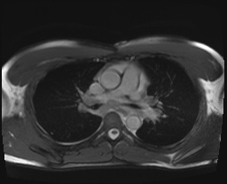 File:Active right ventricular cardiac sarcoidosis (Radiopaedia 55596-62100 Axial SSFP 15).jpg