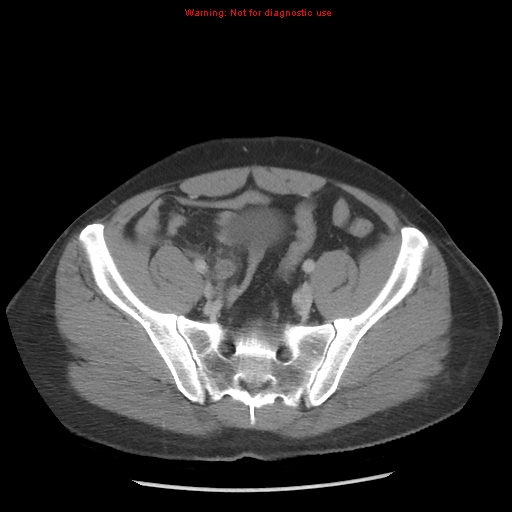 File:Acute appendicitis (Radiopaedia 10498-10973 Axial C+ portal venous phase 36).jpg