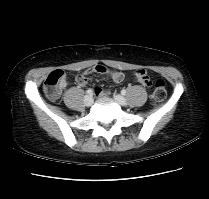 Acute appendicitis (Radiopaedia 22892-22918 Axial C+ portal venous phase 57).png