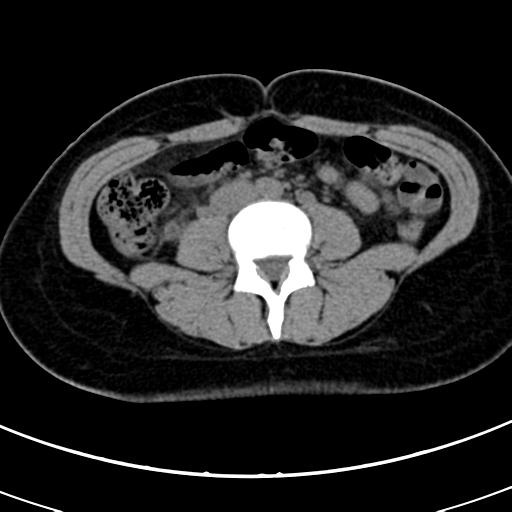 Acute appendicitis (Radiopaedia 30261-30888 Axial non-contrast 46).jpg