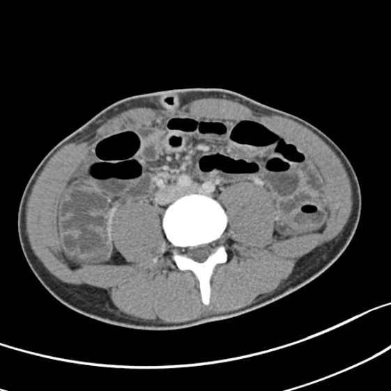 File:Acute appendicitis (Radiopaedia 32614-33572 Axial C+ portal venous phase 39).jpg