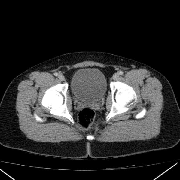 Acute appendicitis (Radiopaedia 38255-40270 Axial C+ portal venous phase 105).jpg