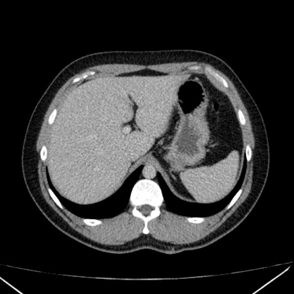 File:Acute appendicitis (Radiopaedia 38255-40270 Axial C+ portal venous phase 19).jpg