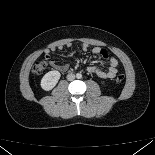 File:Acute appendicitis (Radiopaedia 38255-40270 Axial C+ portal venous phase 54).jpg
