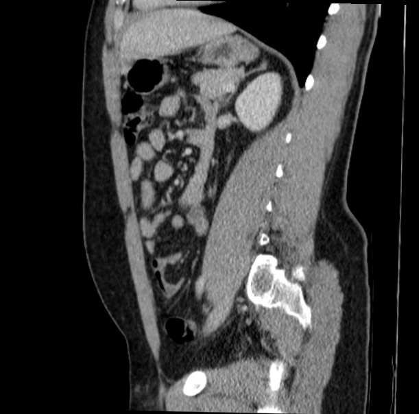 Acute appendicitis (Radiopaedia 38255-40270 Sagittal C+ portal venous phase 53).jpg