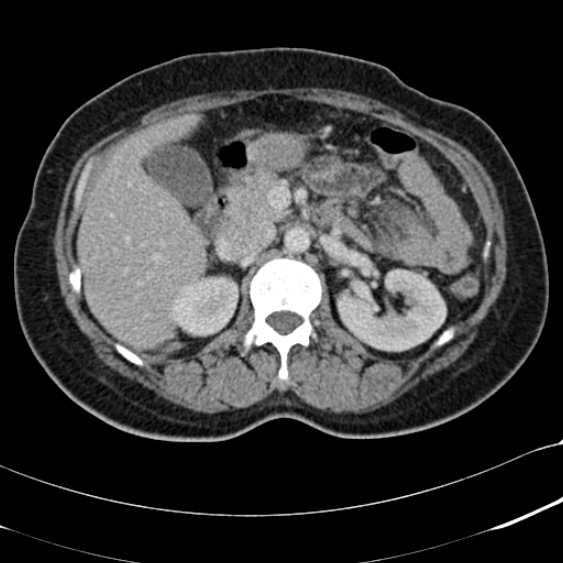 File:Acute appendicitis (Radiopaedia 48792-53822 Axial C+ portal venous phase 40).jpg