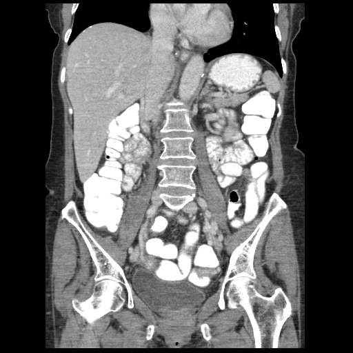 Acute appendicitis (Radiopaedia 52672-58589 Coronal C+ portal venous phase 61).jpg