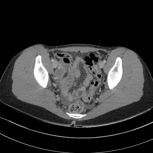 File:Acute appendicitis (Radiopaedia 62608-70901 Axial C+ portal venous phase 40).jpg