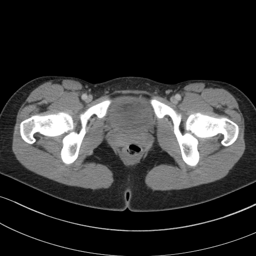 File:Acute appendicitis (Radiopaedia 62608-70901 Axial C+ portal venous phase 61).jpg