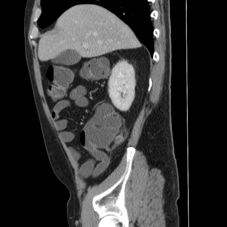 Acute appendicitis (Radiopaedia 66513-75790 Sagittal C+ portal venous phase 38).jpg