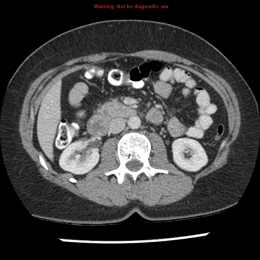 File:Acute appendicitis (Radiopaedia 7966-8812 C+ portal venous phase 17).jpg