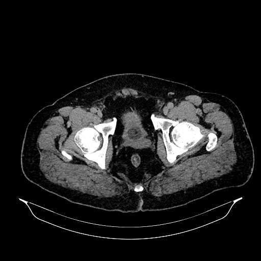Acute appendicitis (Radiopaedia 79950-93224 Axial non-contrast 96).jpg