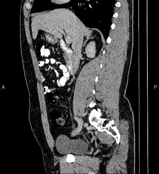 Acute appendicitis (Radiopaedia 84780-100240 Sagittal C+ portal venous phase 40).jpg