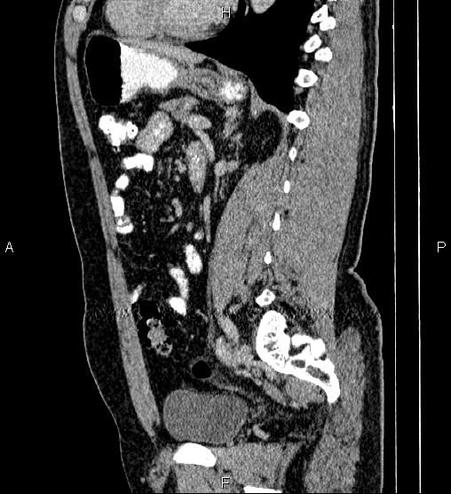 Acute appendicitis (Radiopaedia 84780-100240 Sagittal C+ portal venous phase 64).jpg