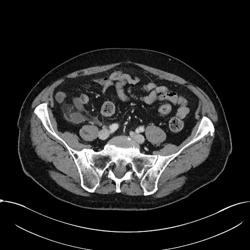 File:Acute appendicitis - large appendicoliths (Radiopaedia 61805-69820 Axial C+ portal venous phase 92).jpg