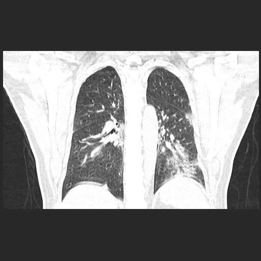 File:Acute appendicitis and COVID 19 pneumonia (Radiopaedia 76604-88380 G 44).jpg