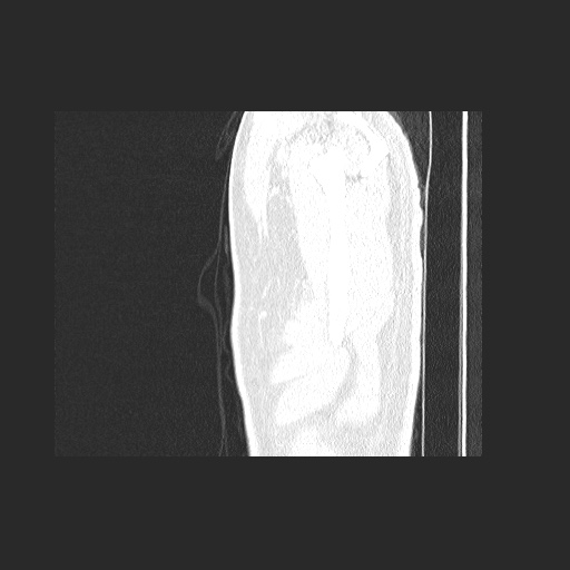 Acute appendicitis and COVID 19 pneumonia (Radiopaedia 76604-88380 Sagittal lung window 4).jpg