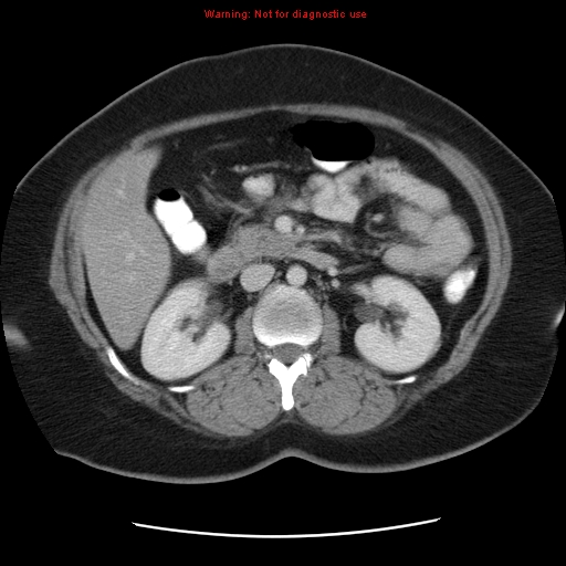 Acute appendicitis complicated by ovarian vein thrombophlebitis (Radiopaedia 16172-15851 Axial C+ portal venous phase 40).jpg