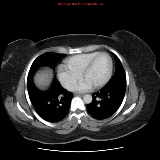 Acute appendicitis complicated by ovarian vein thrombophlebitis (Radiopaedia 16172-15851 Axial C+ portal venous phase 7).jpg