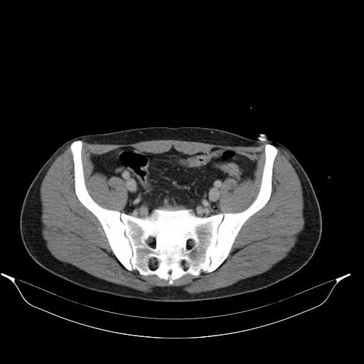 File:Acute appendicitis with appendicoliths (Radiopaedia 21148-21062 Axial C+ portal venous phase 18).jpg