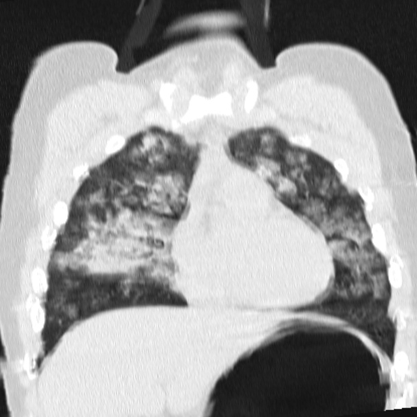 Acute aspiration pneumonitis (Radiopaedia 33605-34703 Coronal lung window 31).jpg
