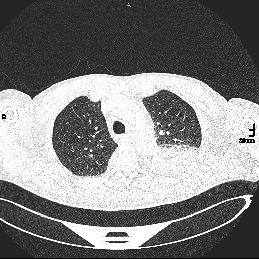 Acute aspiration pneumonitis (Radiopaedia 55642-62166 Axial lung window 52).jpg
