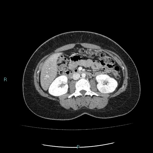 Acute bilateral pyelonephritis (Radiopaedia 37146-38881 Axial C+ portal venous phase 48).jpg