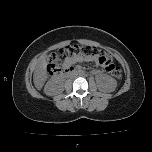File:Acute bilateral pyelonephritis (Radiopaedia 37146-38881 Axial non-contrast 51).jpg
