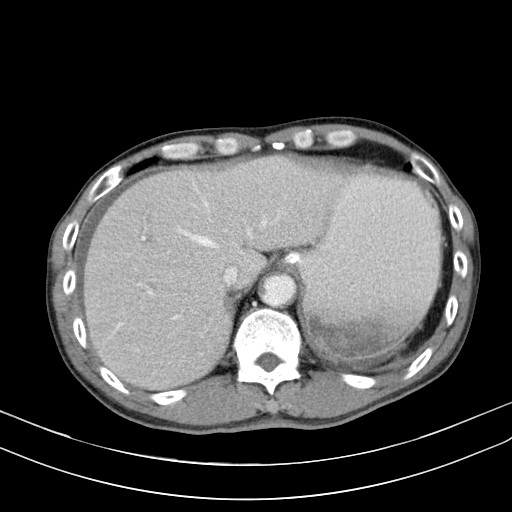 Acute bowel ischemia (Radiopaedia 87695-104114 Axial C+ portal venous phase 17).jpg