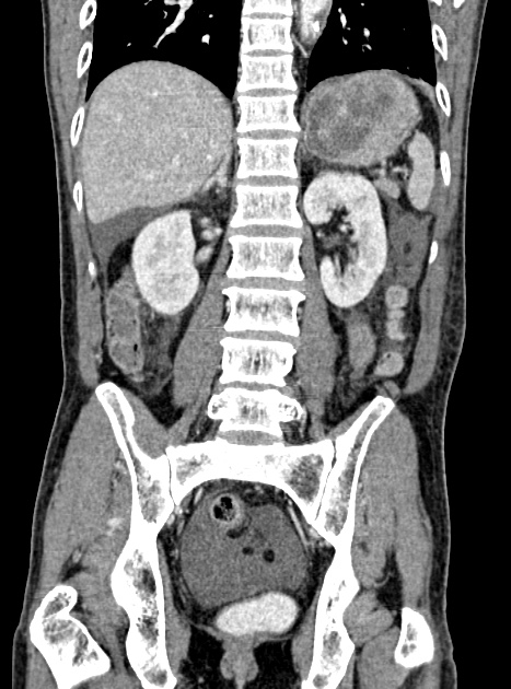 Acute bowel ischemia (Radiopaedia 87695-104114 Coronal C+ portal venous phase 260).jpg