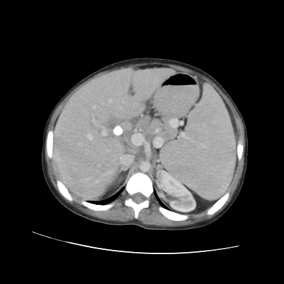 Acute calculous cholecystitis in patient with osteopetrosis (Radiopaedia 77871-90159 Axial C+ portal venous phase 30).jpg
